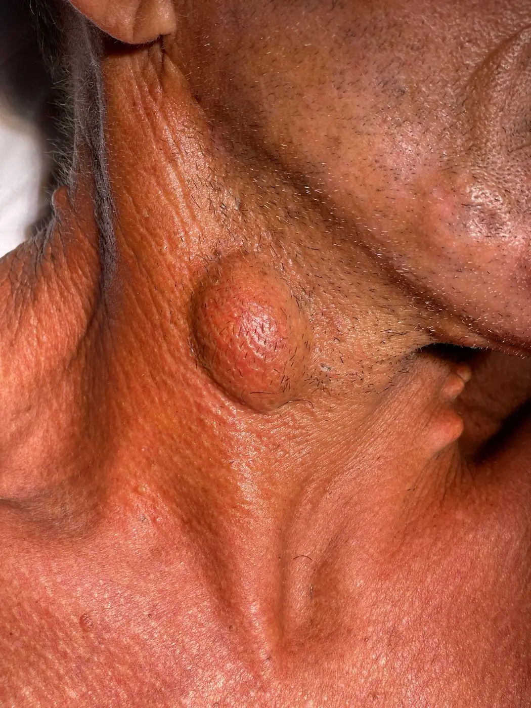 Nódulo subcutâneo (cisto/lipoma) sob a pele