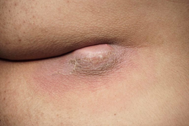 Cirurgia Hospitalar: Cisto Pilonidal