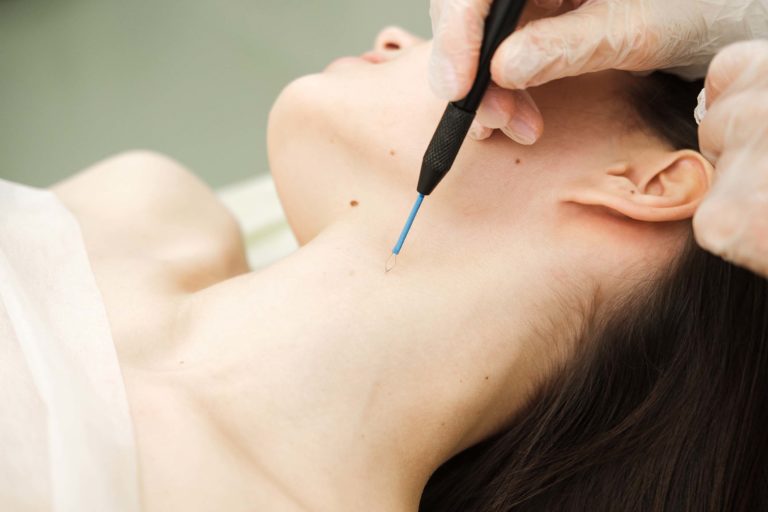 Cirurgia Ambulatorial: Cauterização