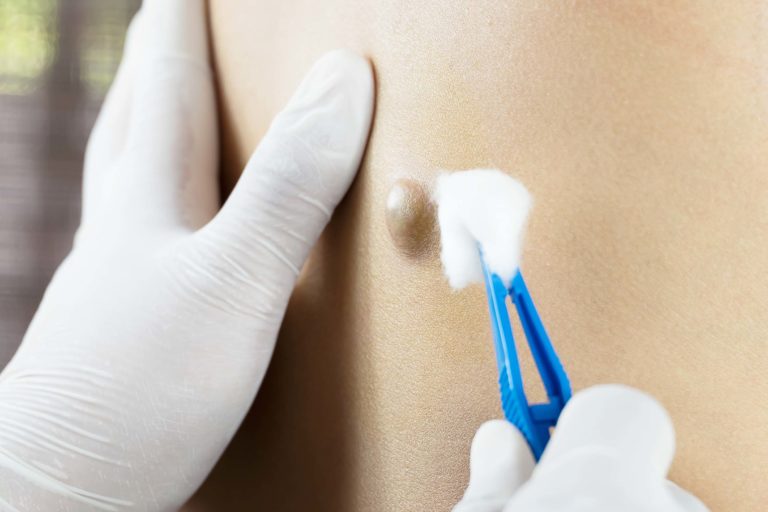 Cirurgia Ambulatorial: Cisto Sebáceo