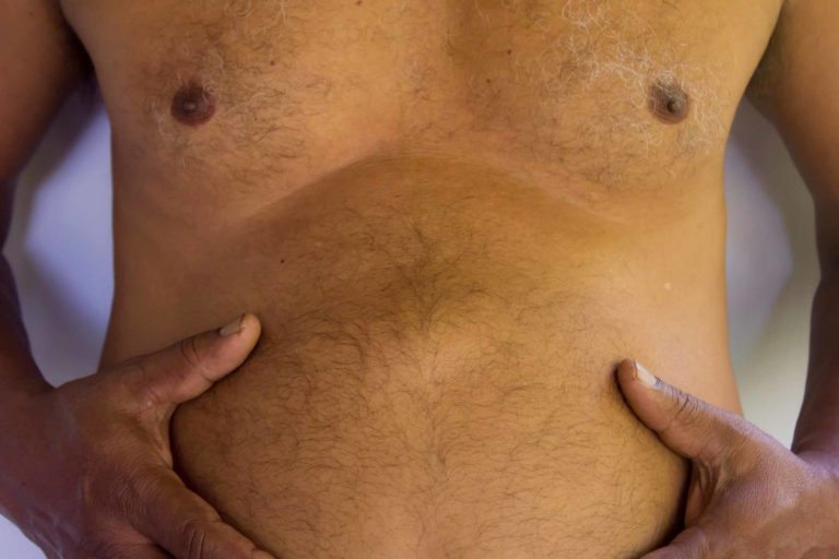 Cirurgia Hospitalar: Hérnia Epigástrica