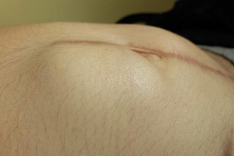 Cirurgia Hospitalar: Hérnia Incisional