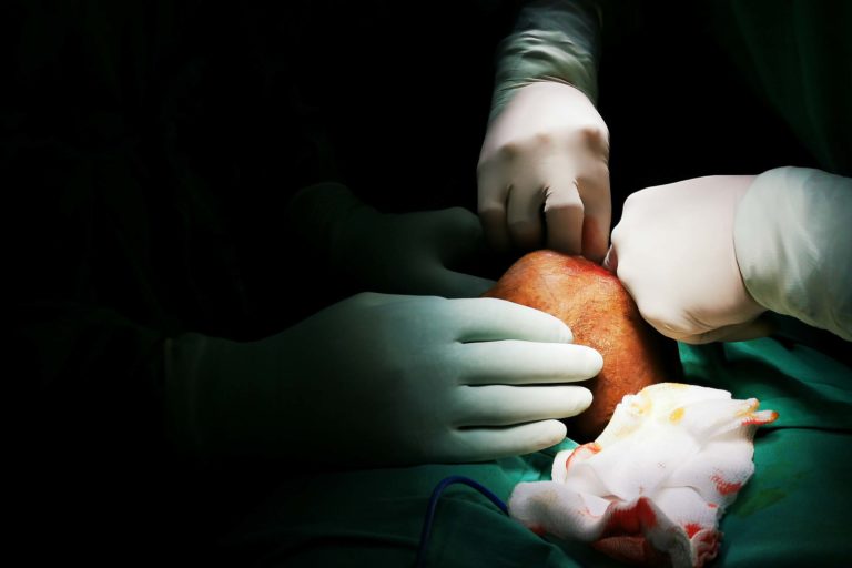 Cirurgia Hospitalar: Hidrocele