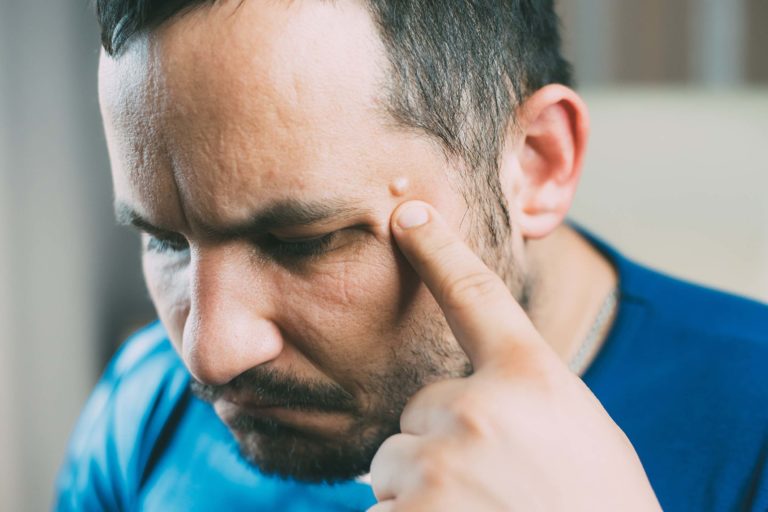 Cirurgia Ambulatorial: Lipoma (Tumor de Gordura)