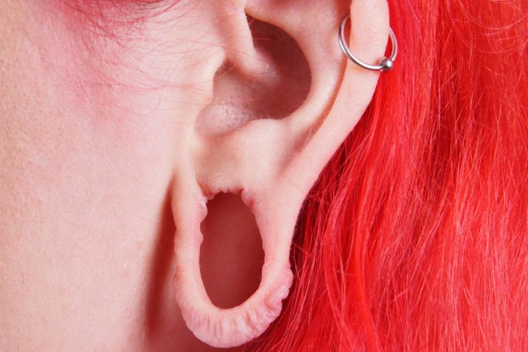 Cirurgia Hospitalar: Lobuloplastia