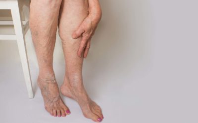 Cirurgia Hospitalar: Varizes