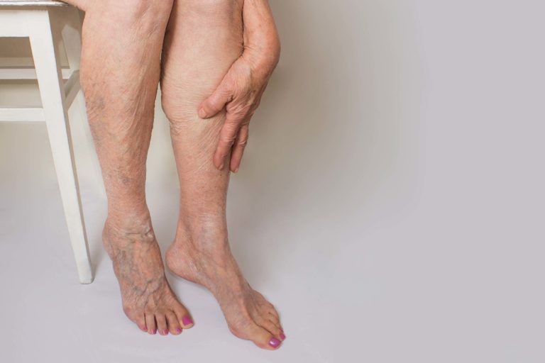 Cirurgia Hospitalar: Varizes