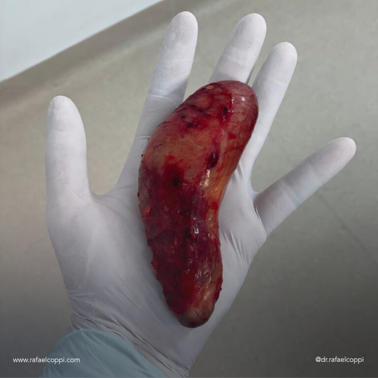 Colecistectomia: cirurgia aberta ou por vídeo?