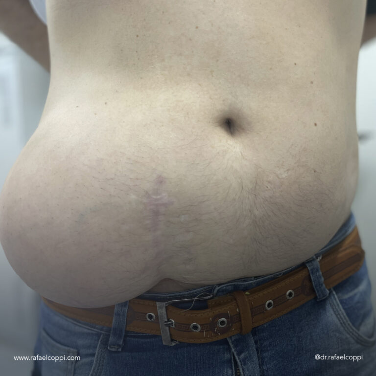 Hérnia de Spiegel – Você sabe o que é?