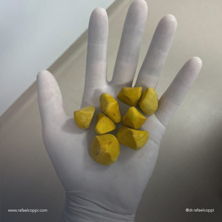 Por que retiramos a vesícula e não apenas os cálculos?